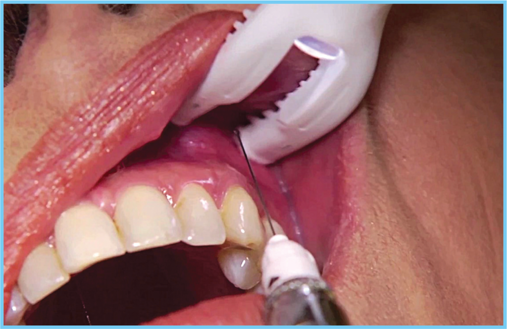 How to use the dentalvibe®.