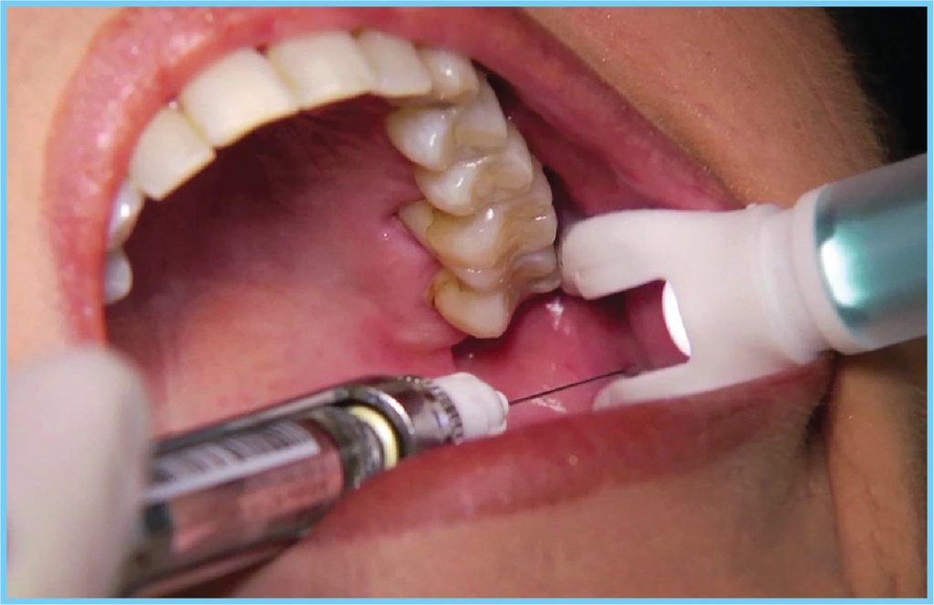 How to use the dentalvibe®.